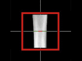 x-ray crop showing how to measure osteoporosis from index metacarpal