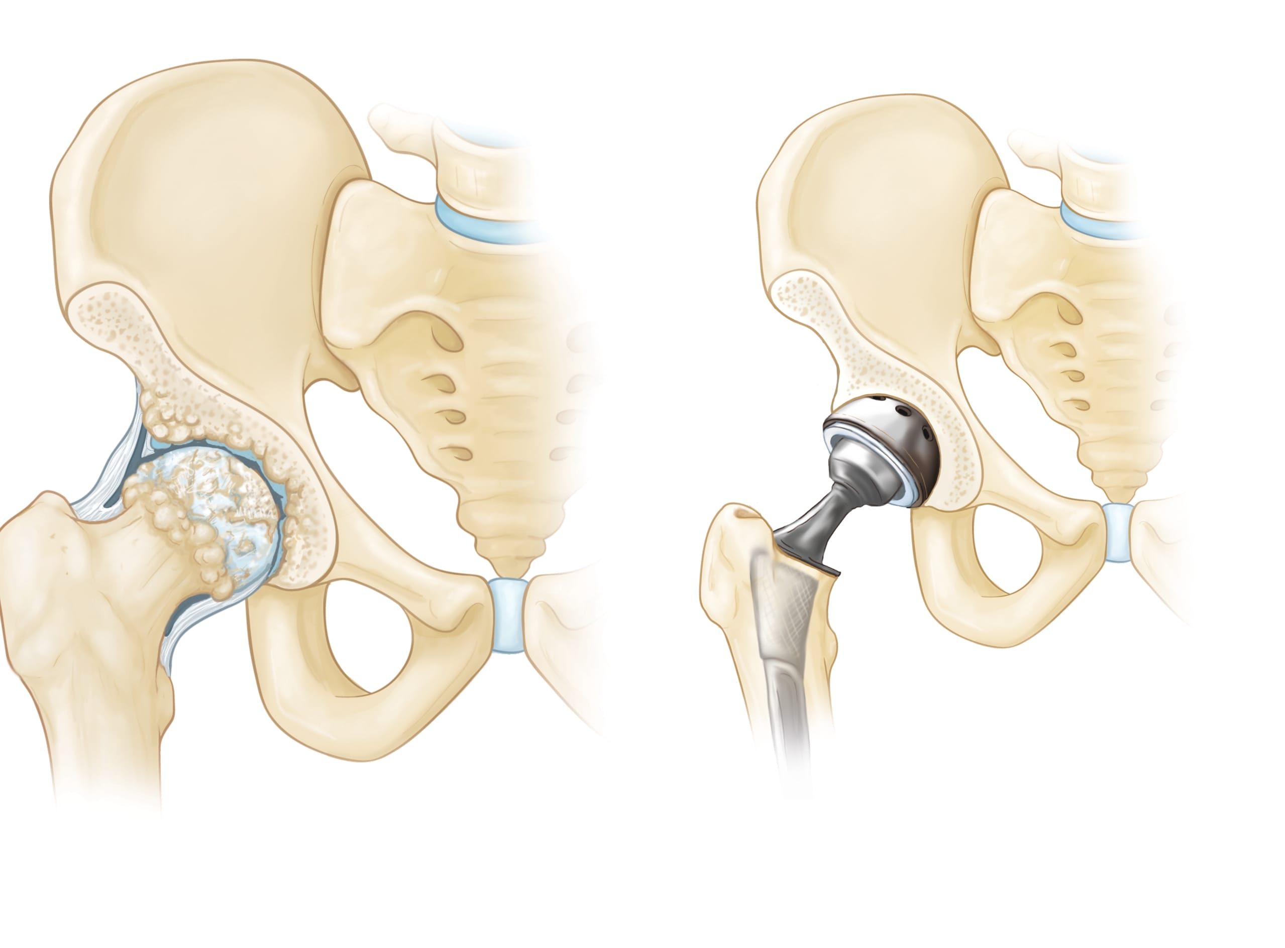 image showing before and after of skeleton of hip replacement
